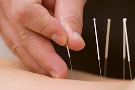 Community Acupuncture